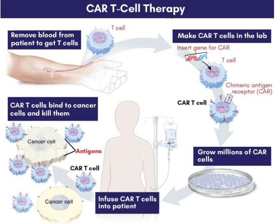 car t therapy